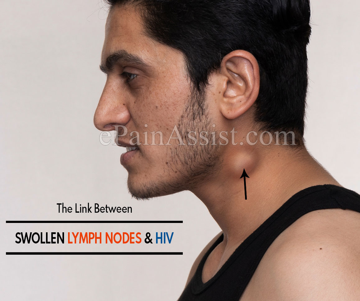 The Link Between Swollen Lymph Nodes And HIV
