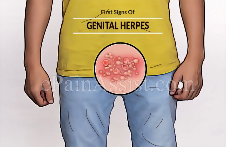 What Are The First Signs Of Genital Herpes?