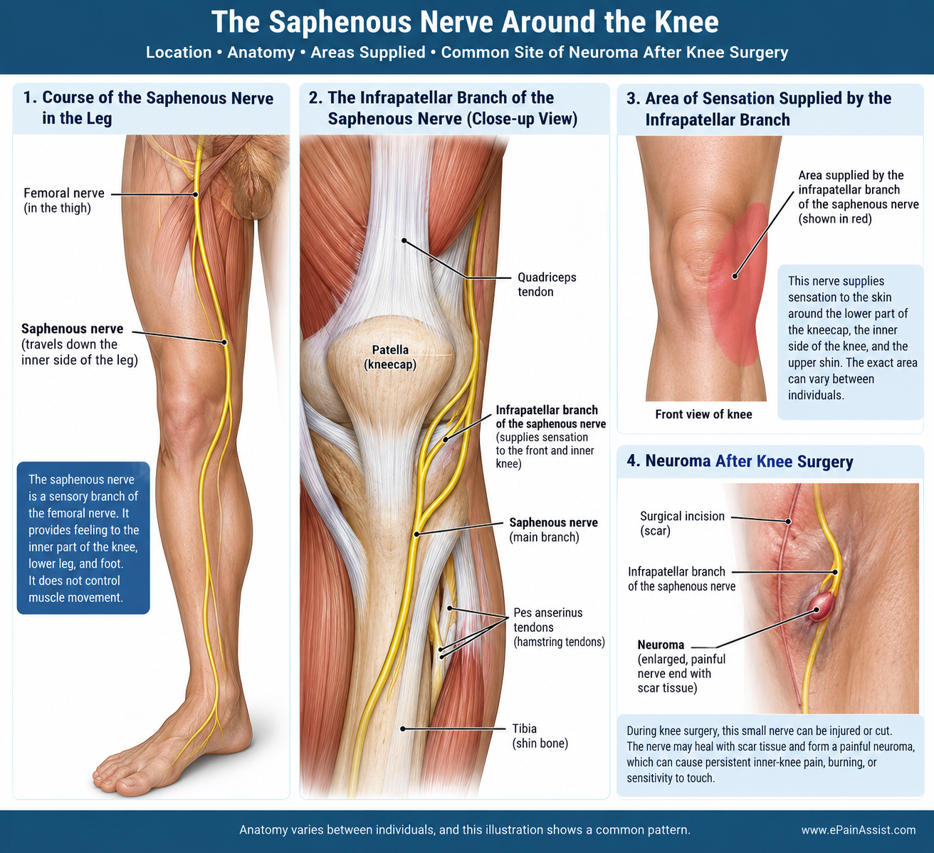 Inner-Knee Pain After Surgery? The Saphenous Nerve May Be the Missing Clue Inner-Knee Pain After Surgery? The Saphenous Nerve May Be the Missing Clue