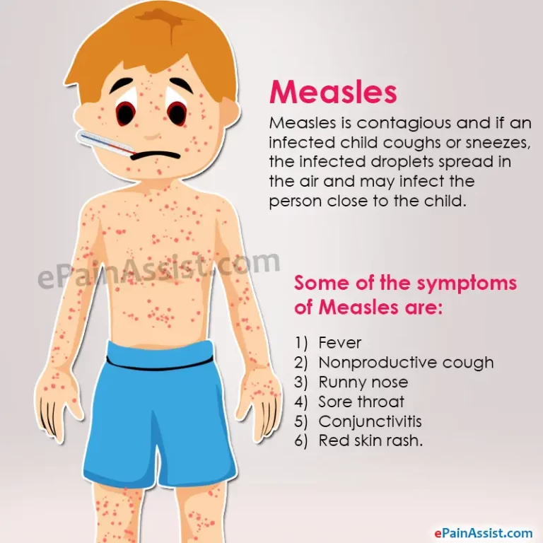 Measles: Causes, Symptoms, Treatment, Home & Natural Remedies