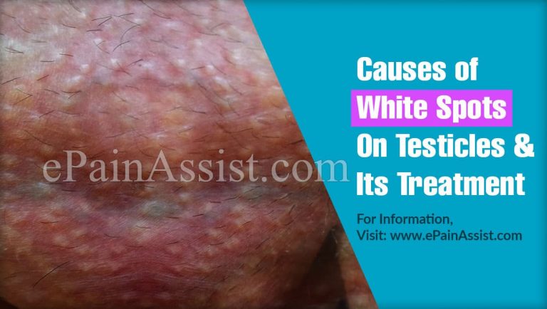 Causes of White Spots On Testicles & Its Treatment