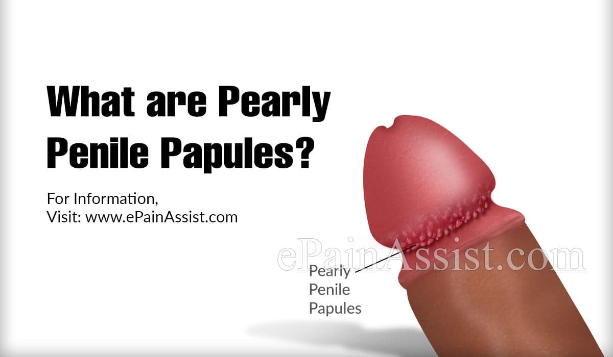 What are Pearly Penile Papules?