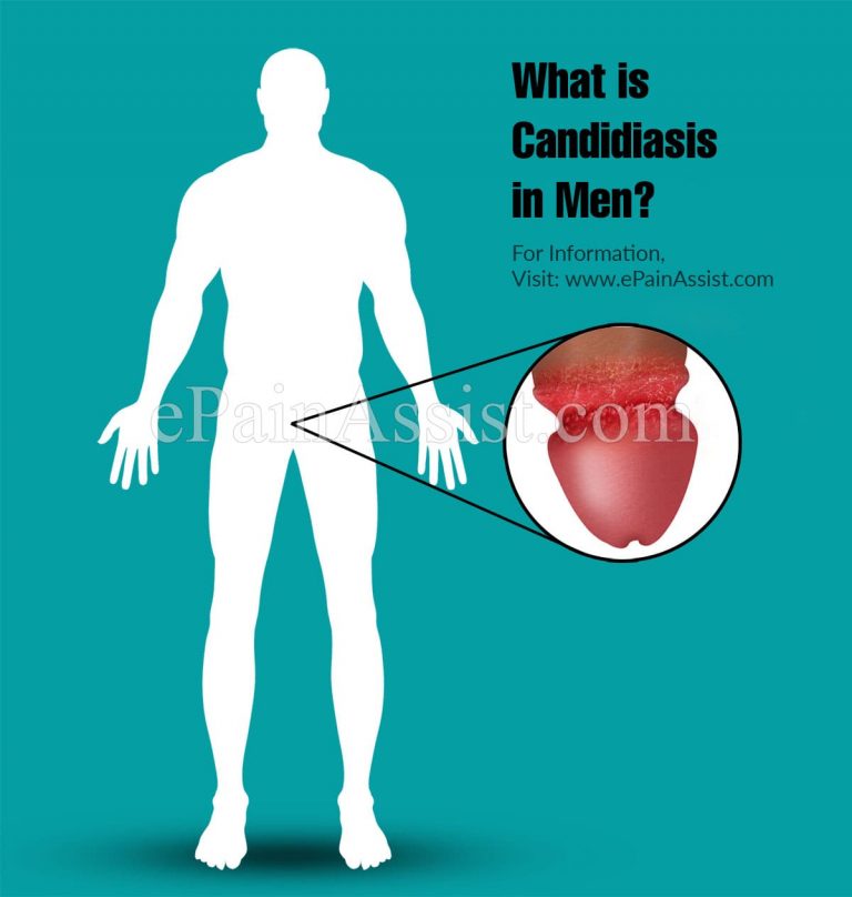 What Are The Presenting Features of Candidiasis in Men & How is it Treated?