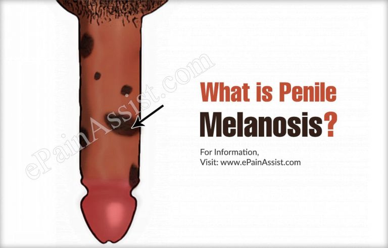 What is Penile Melanosis ?