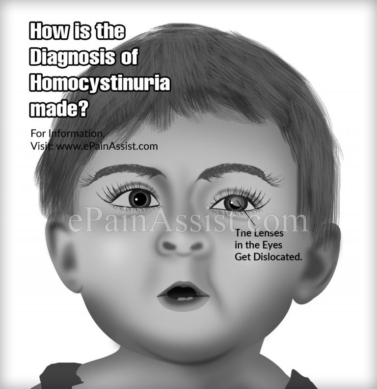 What is Homocystinuria & How is it Treated?|Causes, Symptoms, Prognosis of Homocystinuria