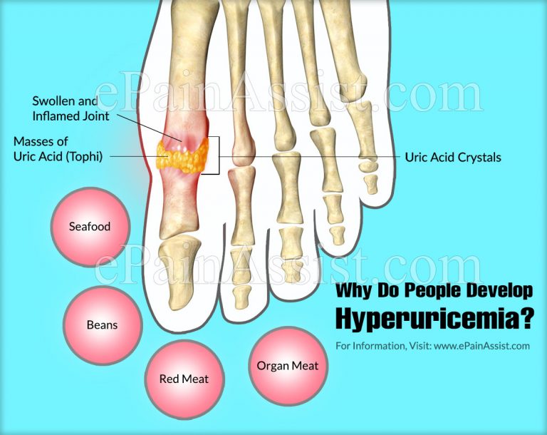 What is Hyperuricemia & How is it Treated? | Why Do People Develop Hyperuricemia?