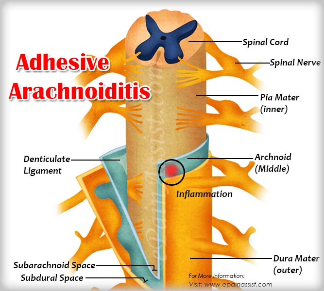 Adhesive Arachnoiditis