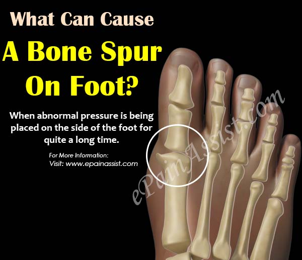 What Can Cause A Bone Spur On Foot?