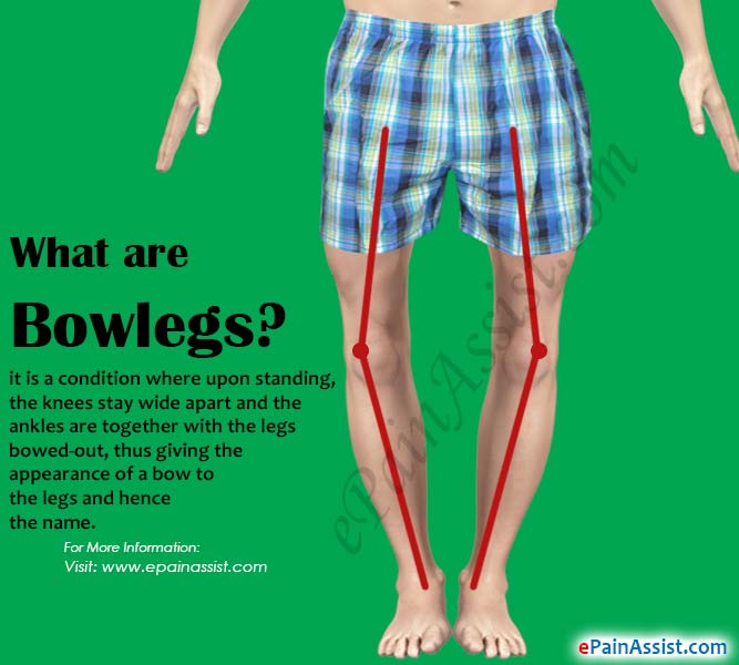 What are Bowlegs or Bandy Legs?