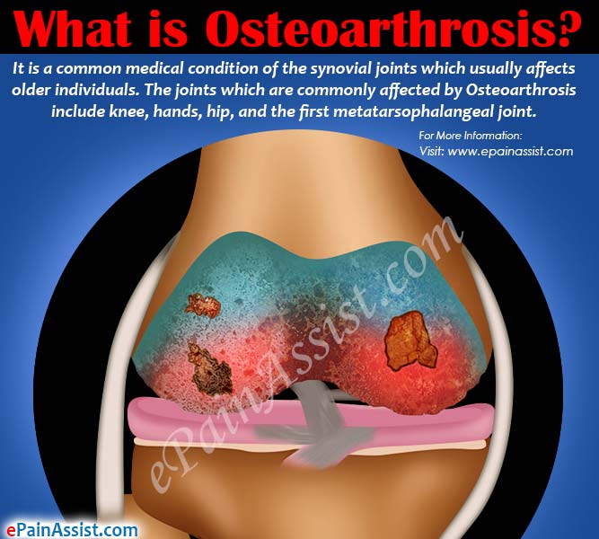 What is Osteoarthrosis?