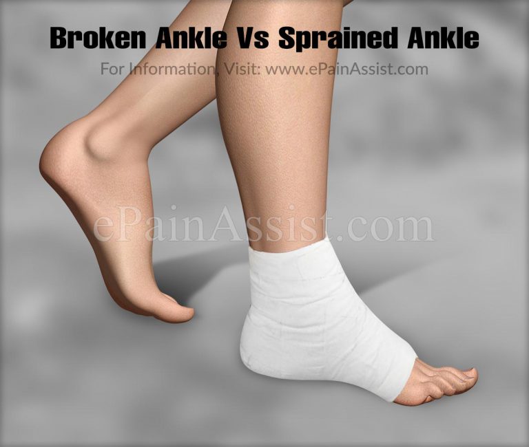Broken Ankle  Vs Sprained Ankle: Differences Based on Causes, Symptoms, Treatment and Recovery