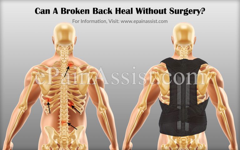 Can A Broken Back Heal Without Surgery?
