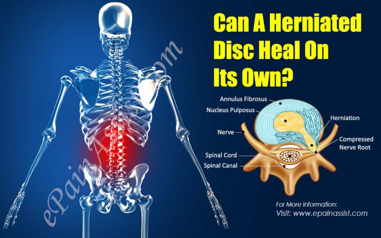Can A Herniated Disc Heal On Its Own?
