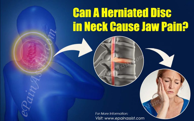Can A Herniated Disc in Neck Cause Jaw Pain?