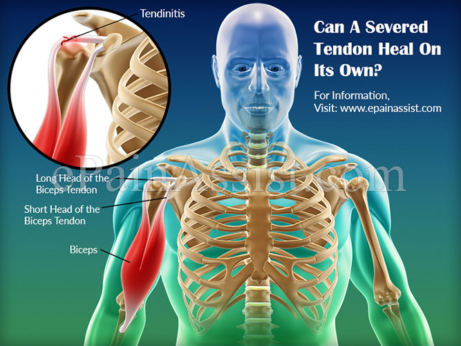 Can A Severed Tendon Heal On Its Own? Can A Severed Tendon Heal On Its Own?