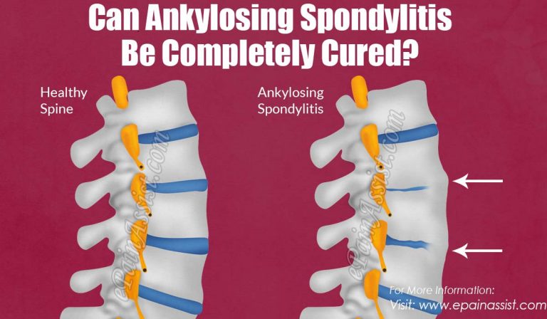 Can Ankylosing Spondylitis Be Completely Cured?