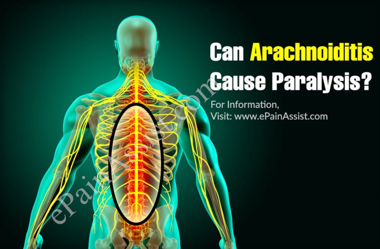 Can Arachnoiditis Cause Paralysis?