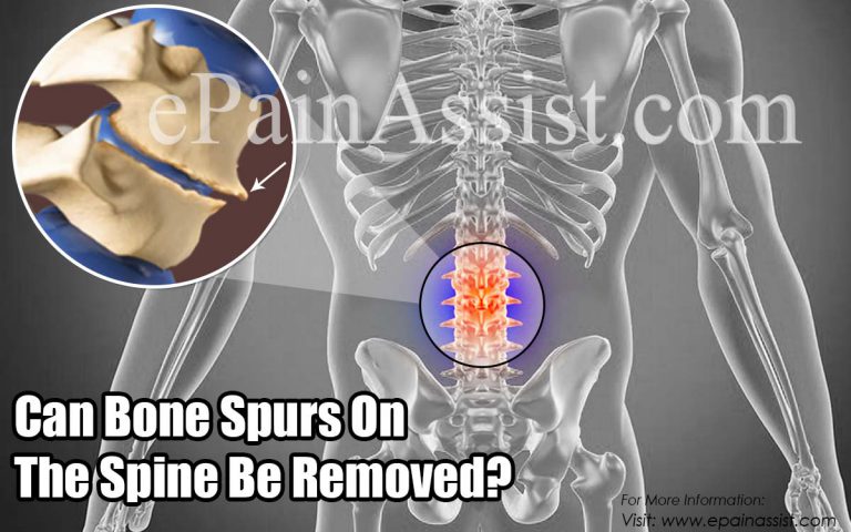 Can Bone Spurs On The Spine Be Removed?