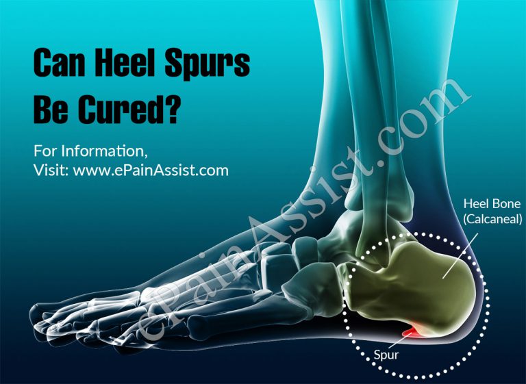 Can Heel Spurs Be Cured?