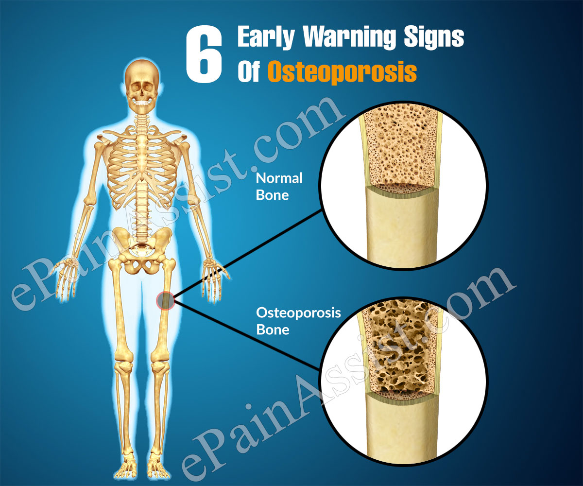 6 Early Warning Signs Of Osteoporosis