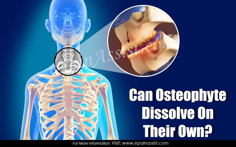 Can Osteophytes Dissolve On Their Own?