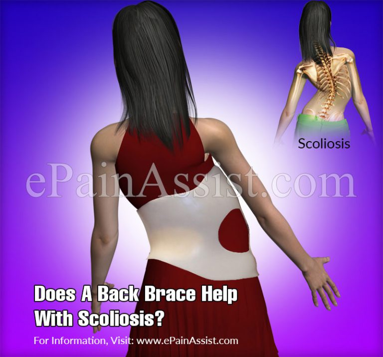 Does A Back Brace Help With Scoliosis?