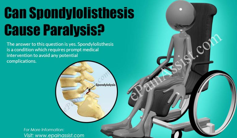 Can Spondylolisthesis Cause Paralysis?