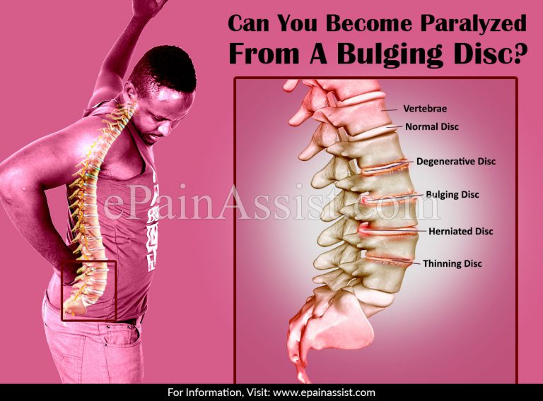 Can You Become Paralyzed From A Bulging Disc?