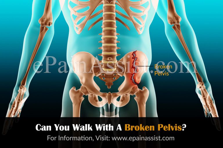 Can You Walk With A Broken Pelvis?