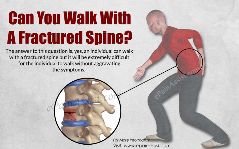 Can You Walk With A Fractured Spine?