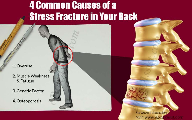 4 Common  Causes of a Stress Fracture in Your Back