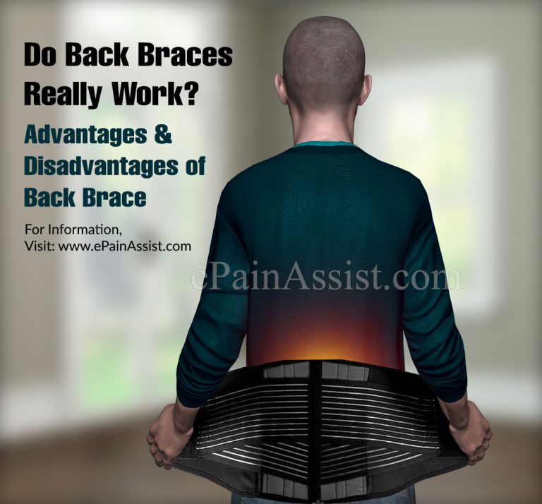 Do Back Braces Really Work?|Advantages & Disadvantages of Back Brace