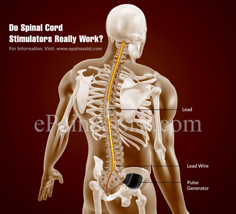 Do Spinal Cord Stimulators Really Work?