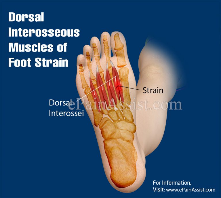 Dorsal Interosseous Muscles of Foot Strain: Causes, Treatment, Recovery Time