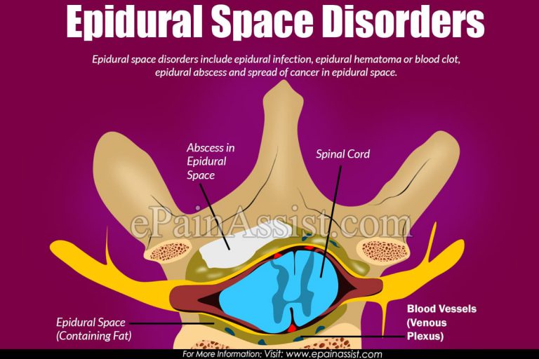 Epidural Space Disorders & Its Signs, Symptoms, Diagnosis