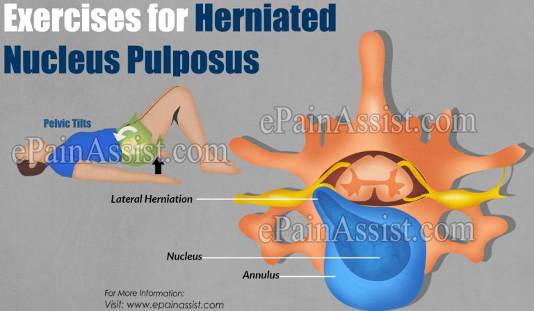 Exercises for Herniated Nucleus Pulposus