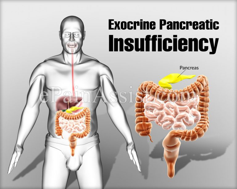 Exocrine Pancreatic Insufficiency