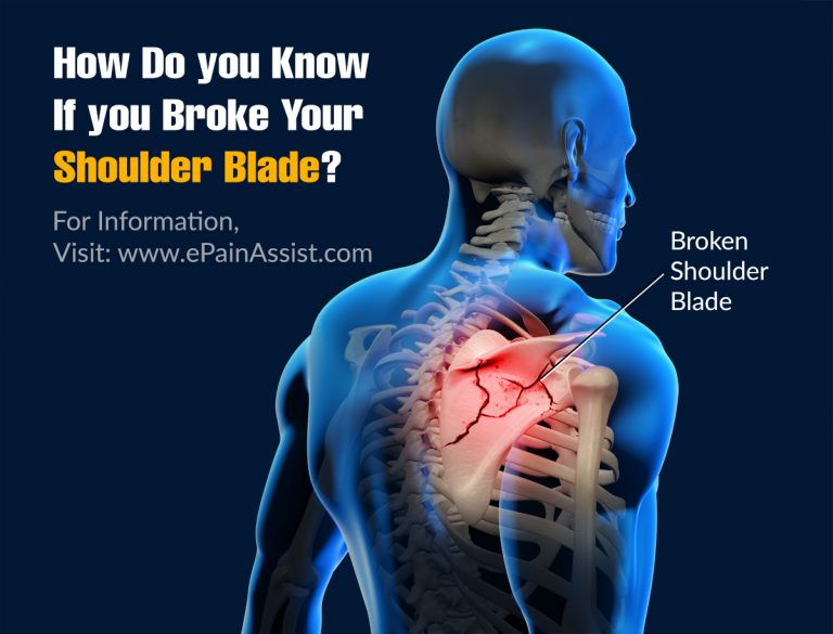 How Do You Know If You Broke Your Shoulder Blade?
