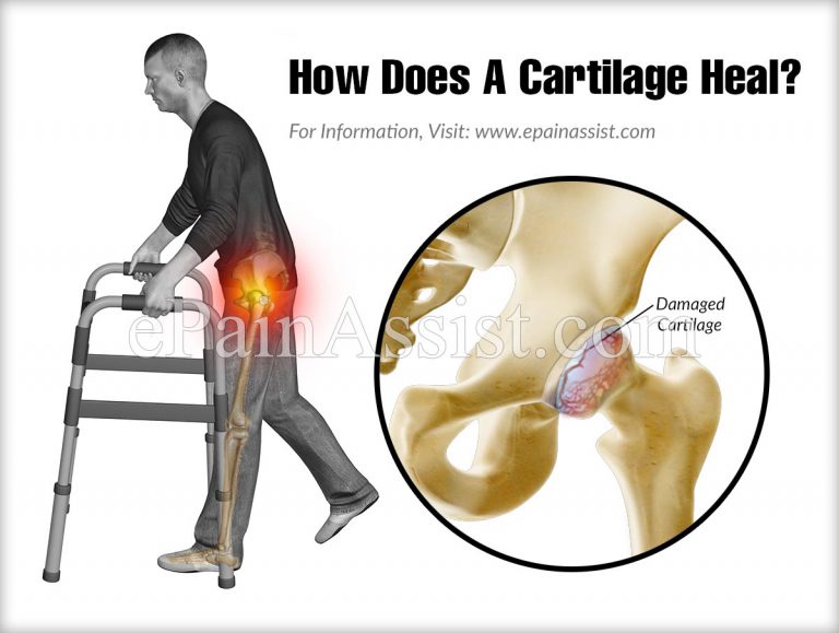How Does A Cartilage Heal?