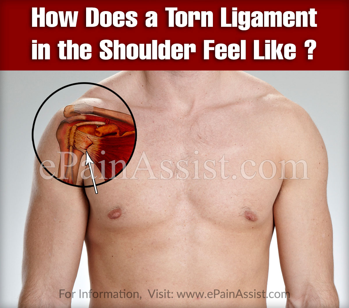 How Does a Torn Ligament in the Shoulder Feel Like?