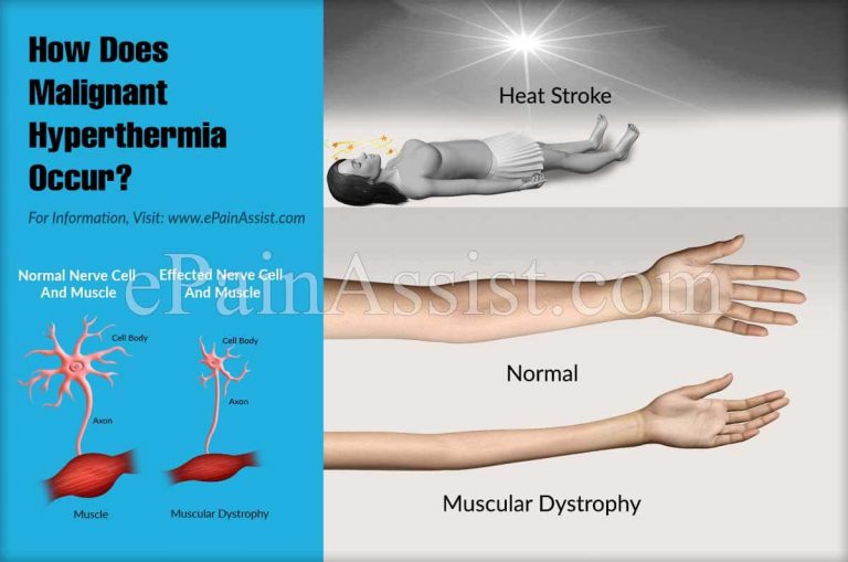 What Is Malignant Hyperthermia And How Does It Occur?