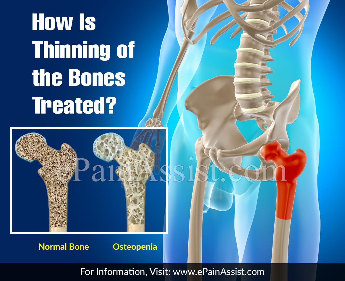 How Is Thinning of the Bones Treated?