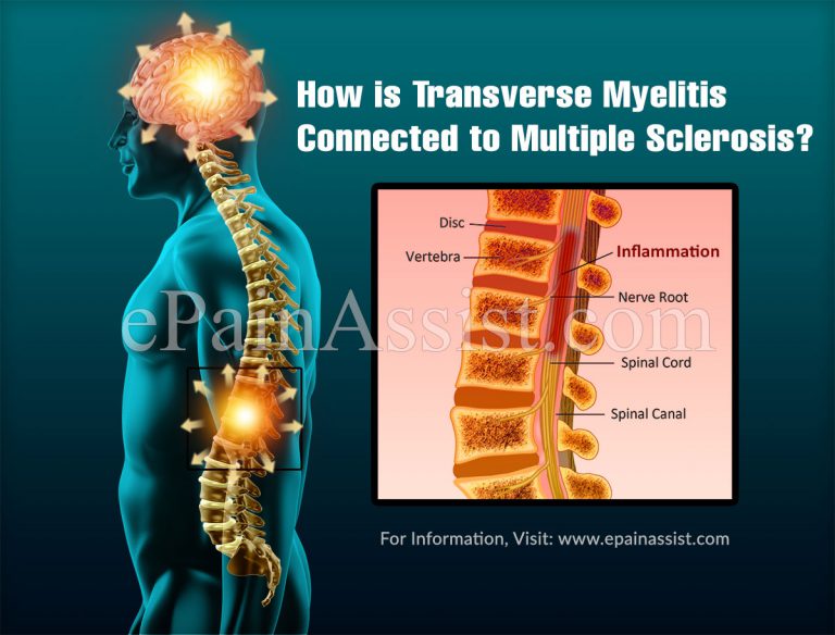 How is Transverse Myelitis Connected to Multiple Sclerosis?