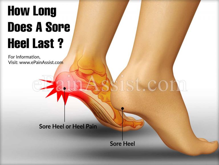 Sore Heels: Causes, How Long Does It Last, Treatments