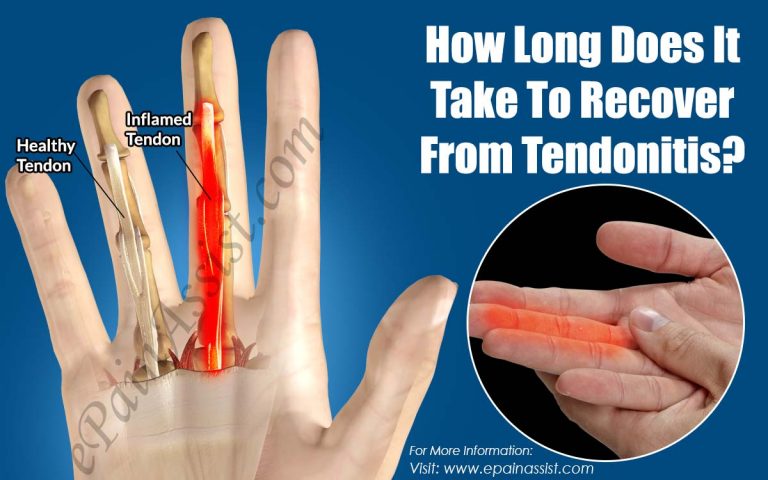 How Long Does It Take To Recover From Tendonitis?