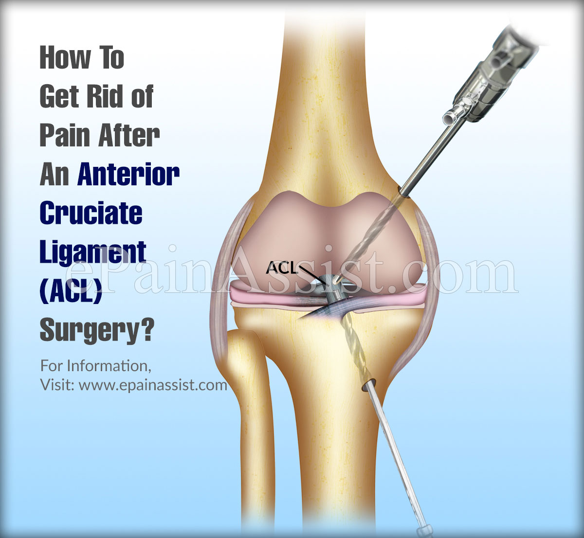 How To Get Rid of Pain After An Anterior Cruciate Ligament (ACL) Surgery?