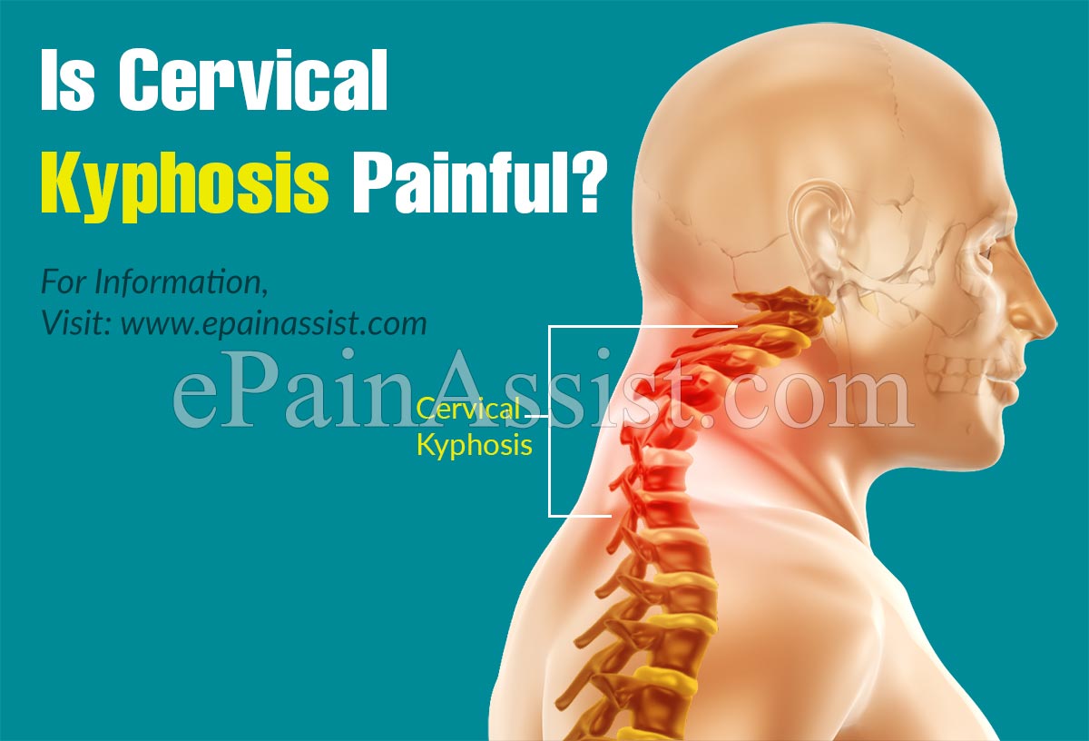 Is Cervical Kyphosis Painful?