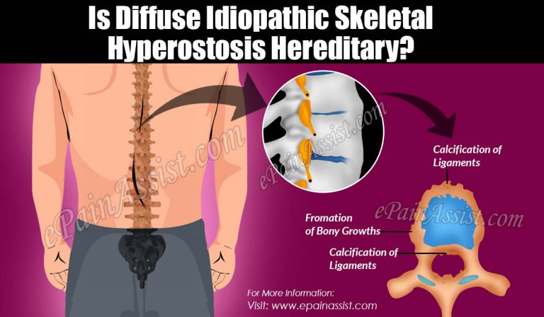 Is Diffuse Idiopathic Skeletal Hyperostosis Hereditary?