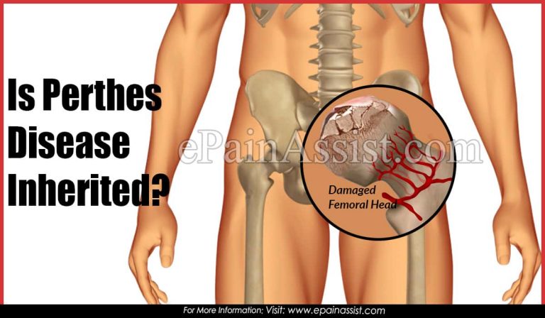 Is Perthes Disease Inherited?