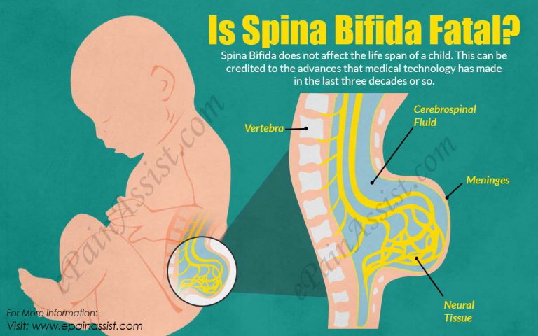 Is Spina Bifida Fatal?